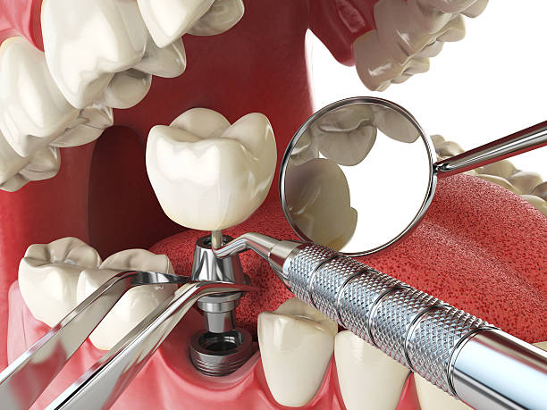 Best Emergency Dental Care for Broken or Chipped Teeth in Trowbridge Park, MI